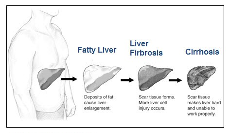 LiverSource - Fatty Liver Disease (Nonalcoholic ...